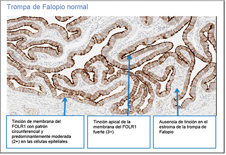 Micrograf&iacute;a que muestra una trompa de Falopio normal con tinci&oacute;n de membrana del FOLR1 predominantemente moderada en c&eacute;lulas epiteliales, tinci&oacute;n apical fuerte y ausencia de tinci&oacute;n en el estroma.

Descripci&oacute;n generada con IA