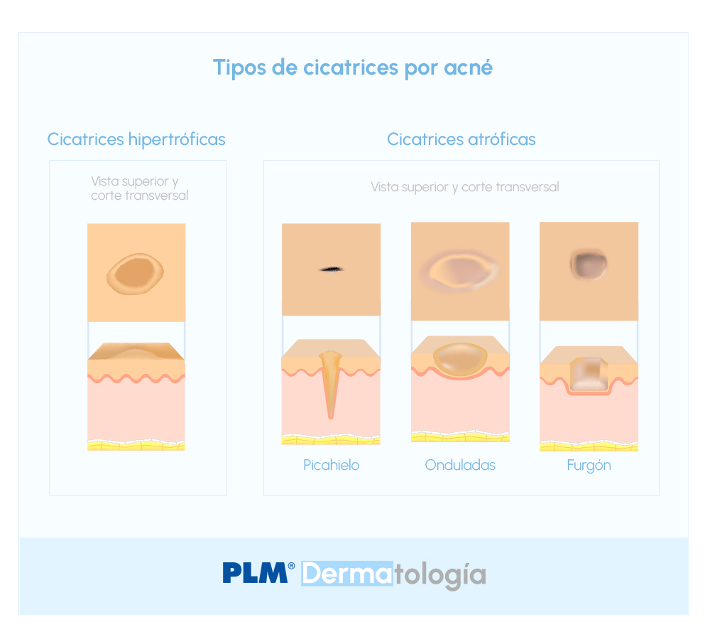 Tipo de cicatrices por acné